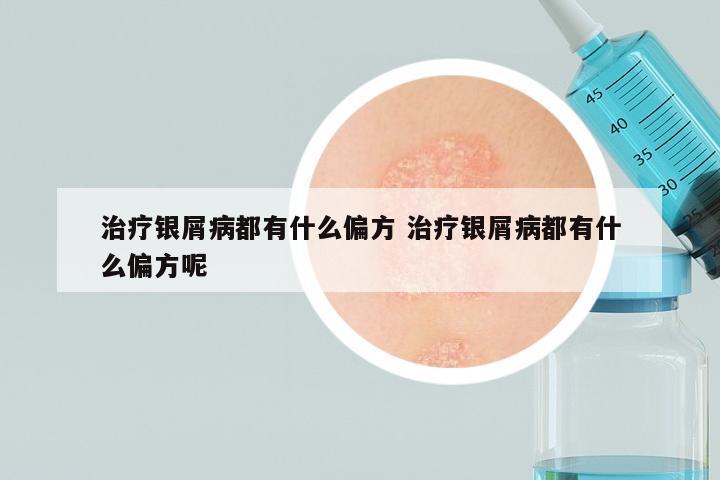 治疗银屑病都有什么偏方 治疗银屑病都有什么偏方呢