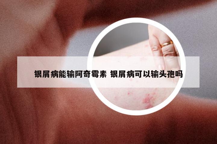 银屑病能输阿奇霉素 银屑病可以输头孢吗