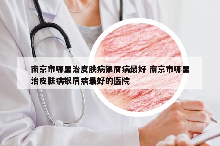 南京市哪里治皮肤病银屑病最好 南京市哪里治皮肤病银屑病最好的医院