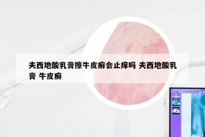 夫西地酸乳膏擦牛皮癣会止痒吗 夫西地酸乳膏 牛皮癣