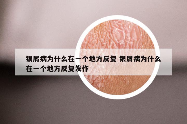 银屑病为什么在一个地方反复 银屑病为什么在一个地方反复发作