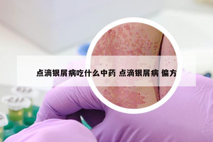 点滴银屑病吃什么中药 点滴银屑病 偏方