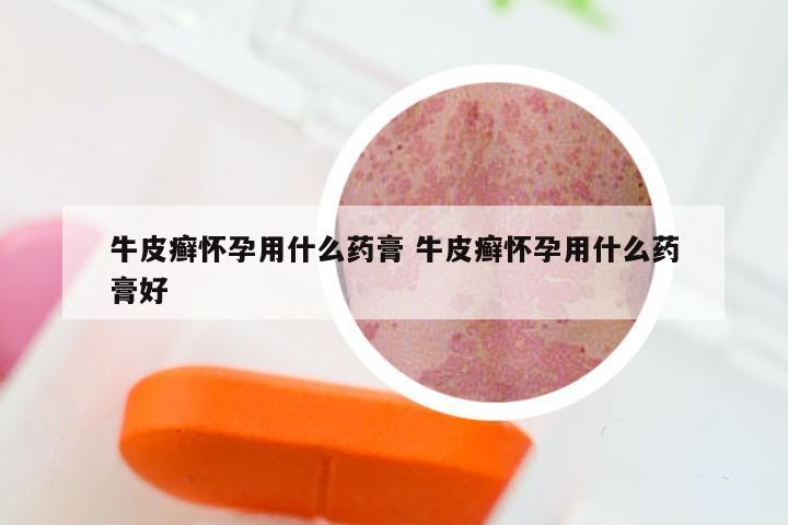 牛皮癣怀孕用什么药膏 牛皮癣怀孕用什么药膏好