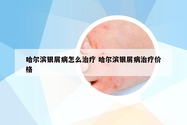 哈尔滨银屑病怎么治疗 哈尔滨银屑病治疗价格