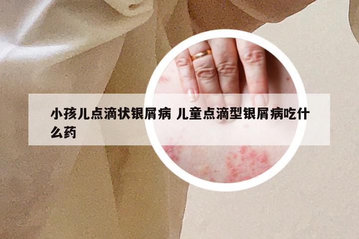 小孩儿点滴状银屑病 儿童点滴型银屑病吃什么药