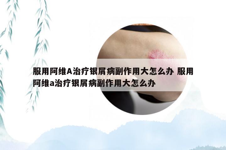 服用阿维A治疗银屑病副作用大怎么办 服用阿维a治疗银屑病副作用大怎么办