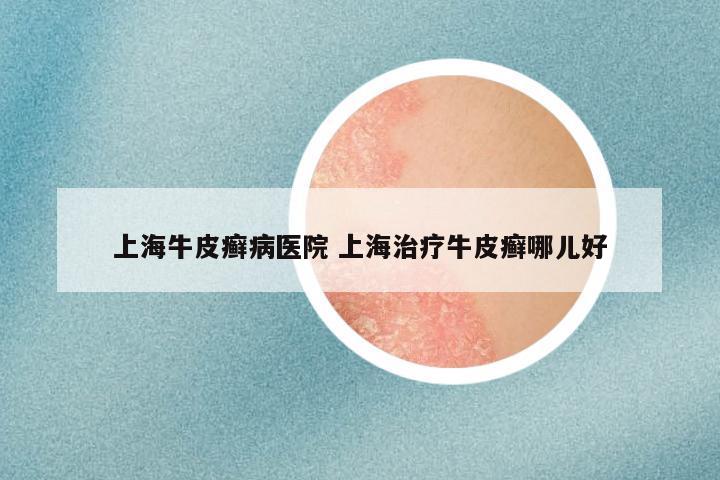 上海牛皮癣病医院 上海治疗牛皮癣哪儿好