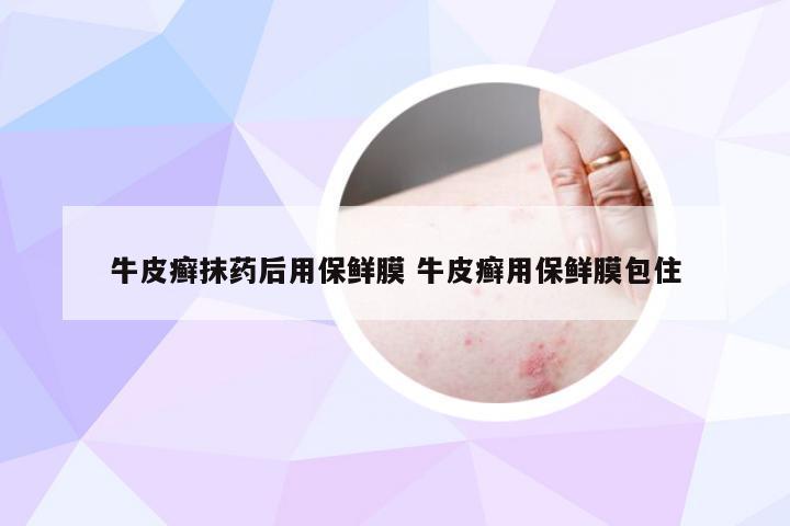 牛皮癣抹药后用保鲜膜 牛皮癣用保鲜膜包住