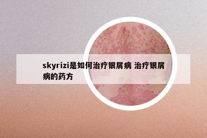 skyrizi是如何治疗银屑病 治疗银屑病的药方