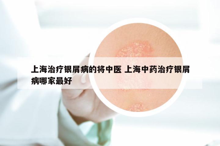 上海治疗银屑病的将中医 上海中药治疗银屑病哪家最好