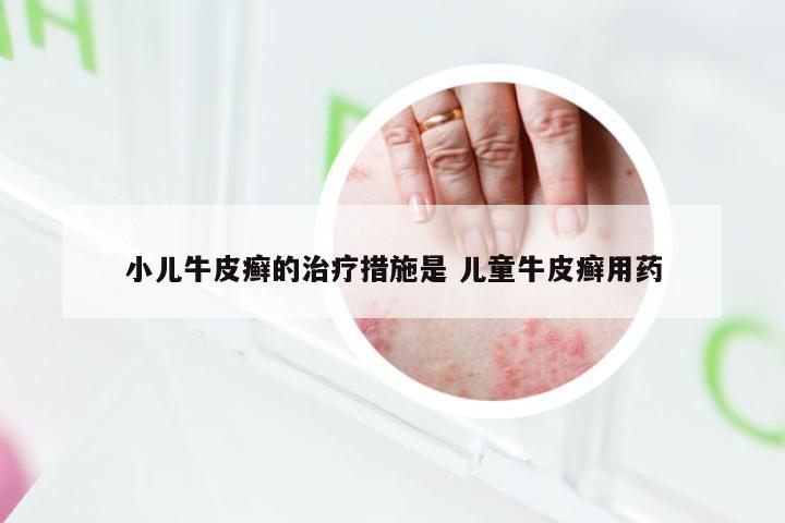 小儿牛皮癣的治疗措施是 儿童牛皮癣用药