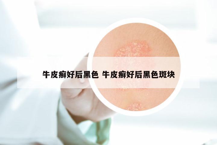 牛皮癣好后黑色 牛皮癣好后黑色斑块