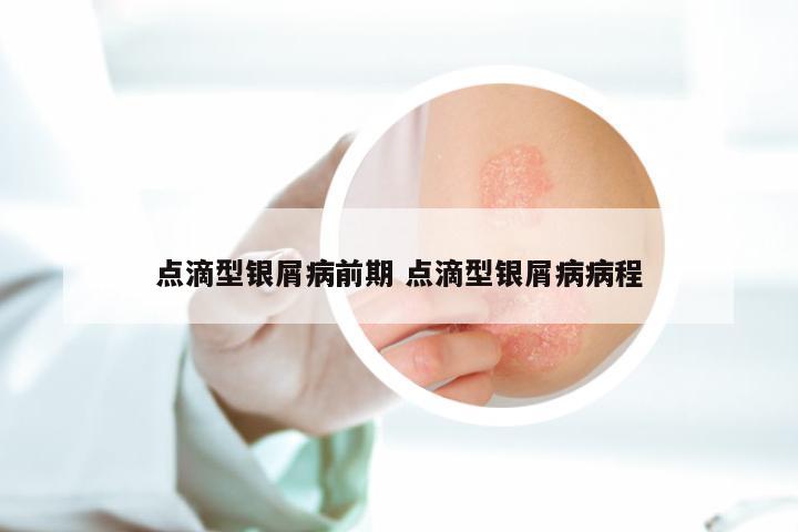 点滴型银屑病前期 点滴型银屑病病程