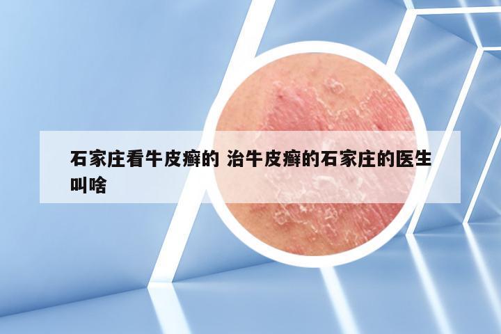 石家庄看牛皮癣的 治牛皮癣的石家庄的医生叫啥