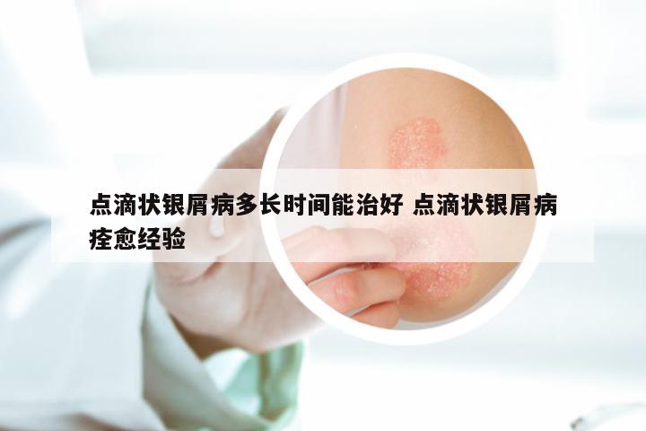 点滴状银屑病多长时间能治好 点滴状银屑病痊愈经验