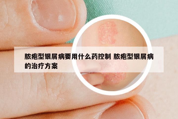 脓疱型银屑病要用什么药控制 脓疱型银屑病的治疗方案