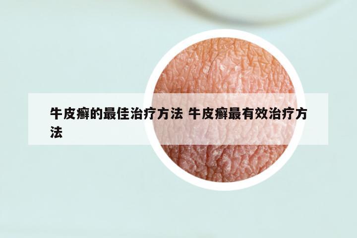 牛皮癣的最佳治疗方法 牛皮癣最有效治疗方法
