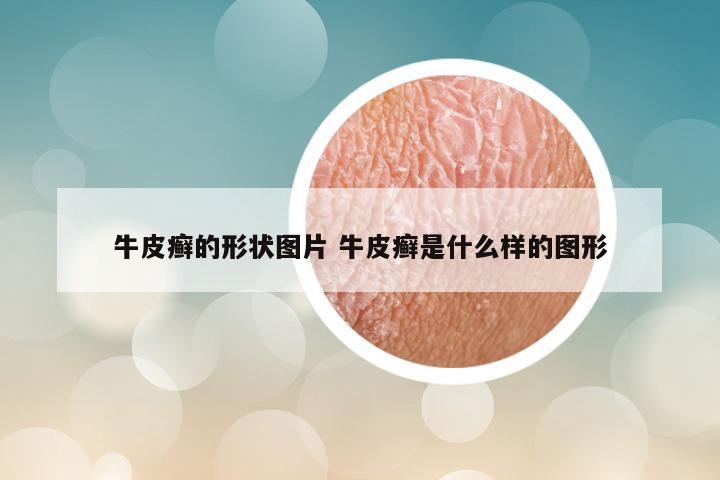 牛皮癣的形状图片 牛皮癣是什么样的图形