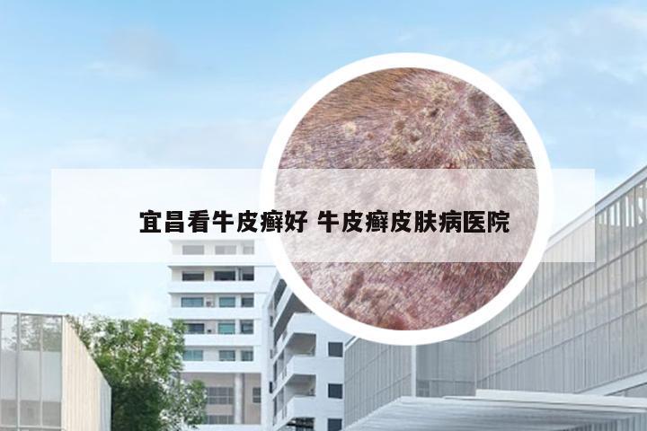宜昌看牛皮癣好 牛皮癣皮肤病医院