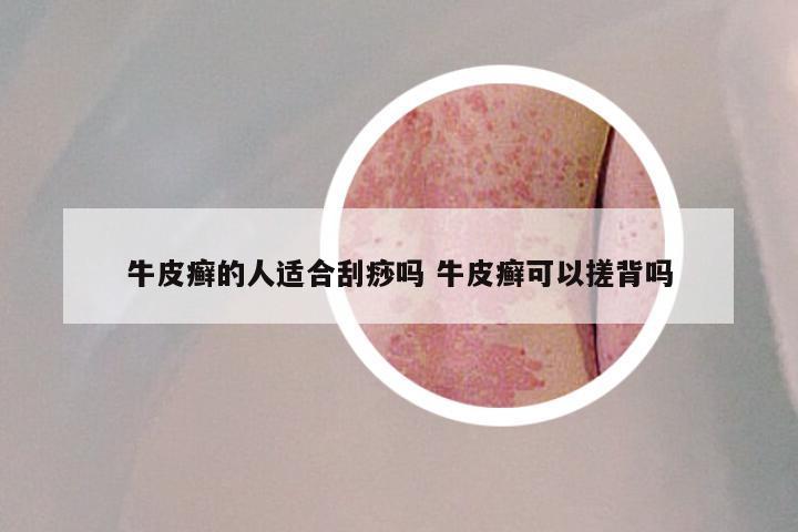 牛皮癣的人适合刮痧吗 牛皮癣可以搓背吗