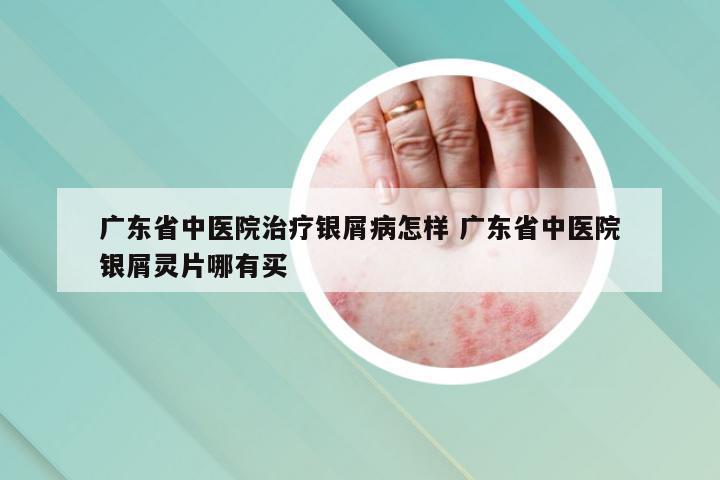 广东省中医院治疗银屑病怎样 广东省中医院银屑灵片哪有买