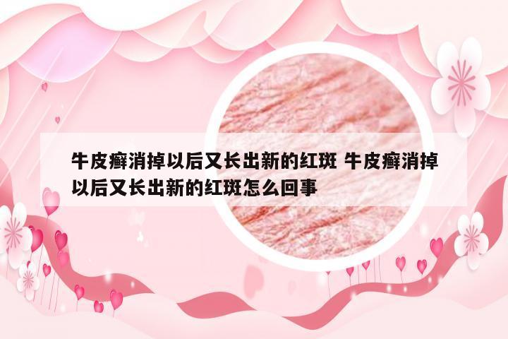 牛皮癣消掉以后又长出新的红斑 牛皮癣消掉以后又长出新的红斑怎么回事