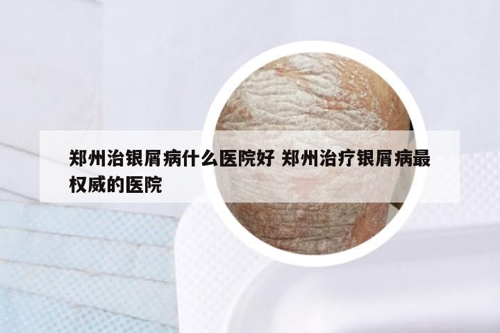 郑州治银屑病什么医院好 郑州治疗银屑病最权威的医院