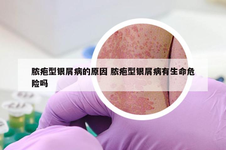 脓疱型银屑病的原因 脓疱型银屑病有生命危险吗