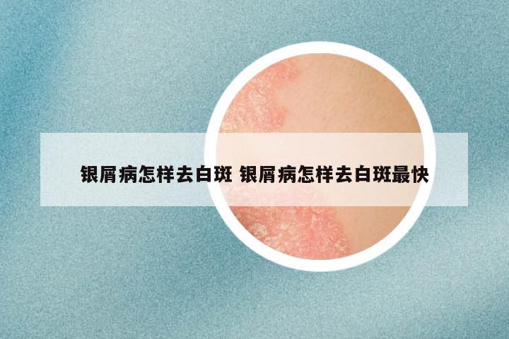 银屑病怎样去白斑 银屑病怎样去白斑最快