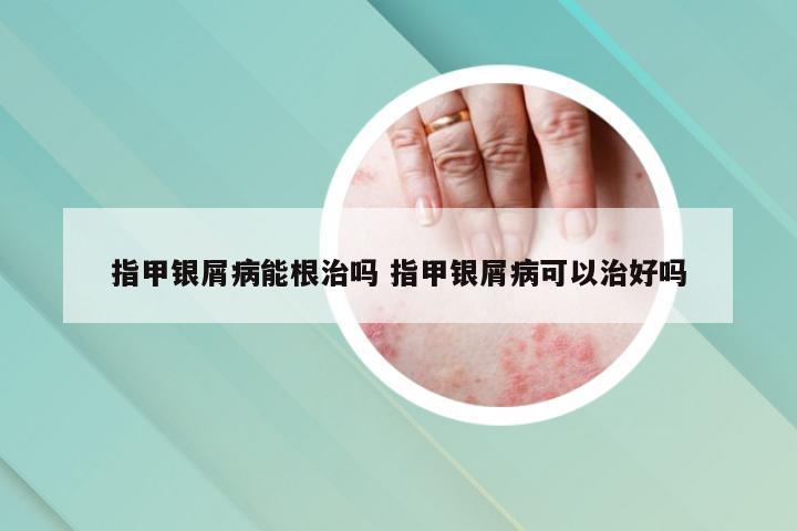 指甲银屑病能根治吗 指甲银屑病可以治好吗