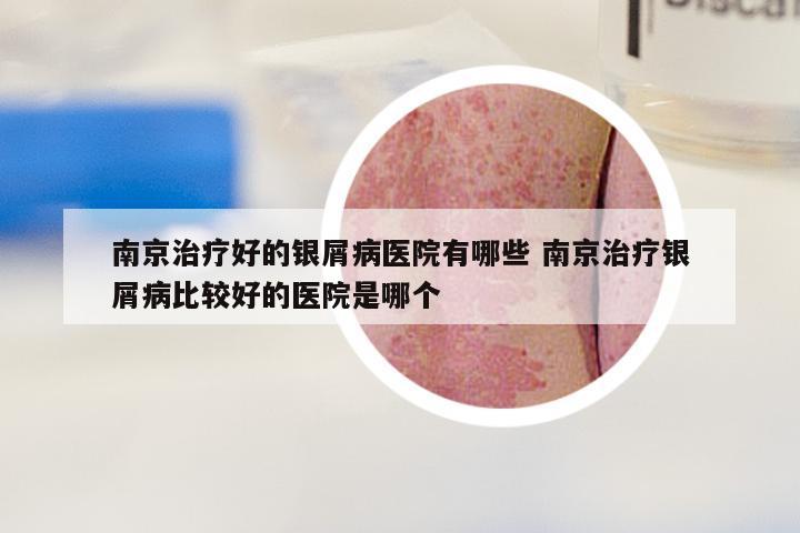 南京治疗好的银屑病医院有哪些 南京治疗银屑病比较好的医院是哪个