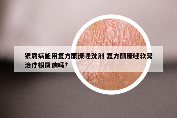 银屑病能用复方酮康唑洗剂 复方酮康唑软膏治疗银屑病吗?