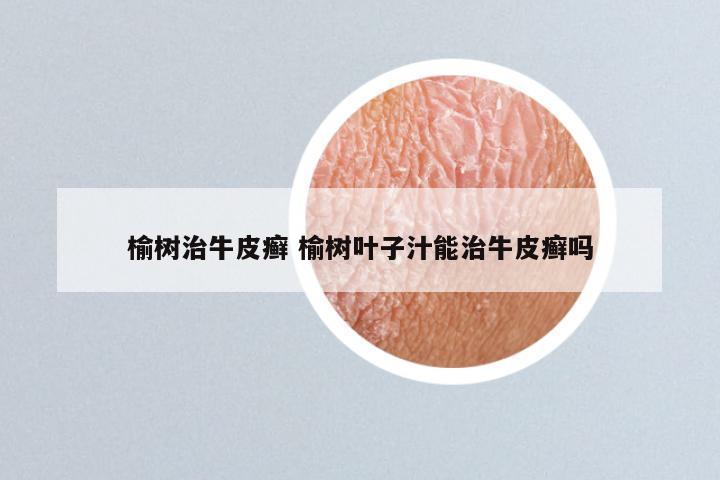 榆树治牛皮癣 榆树叶子汁能治牛皮癣吗