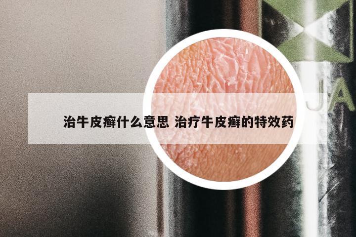 治牛皮癣什么意思 治疗牛皮癣的特效药