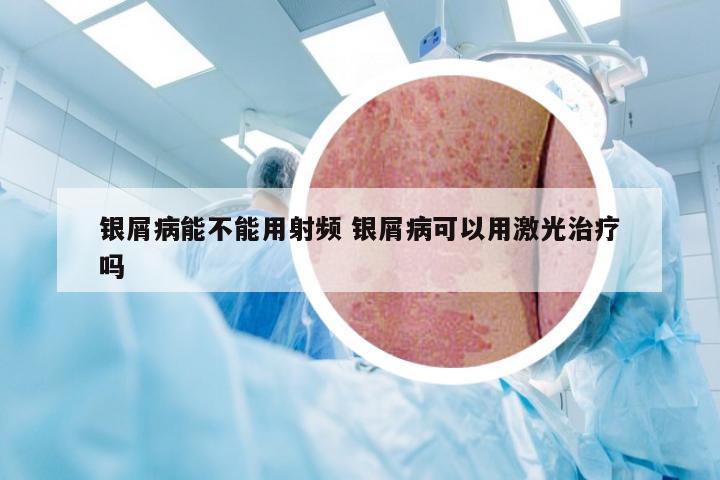 银屑病能不能用射频 银屑病可以用激光治疗吗