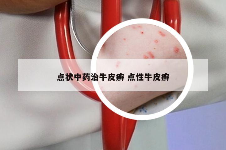 点状中药治牛皮癣 点性牛皮癣