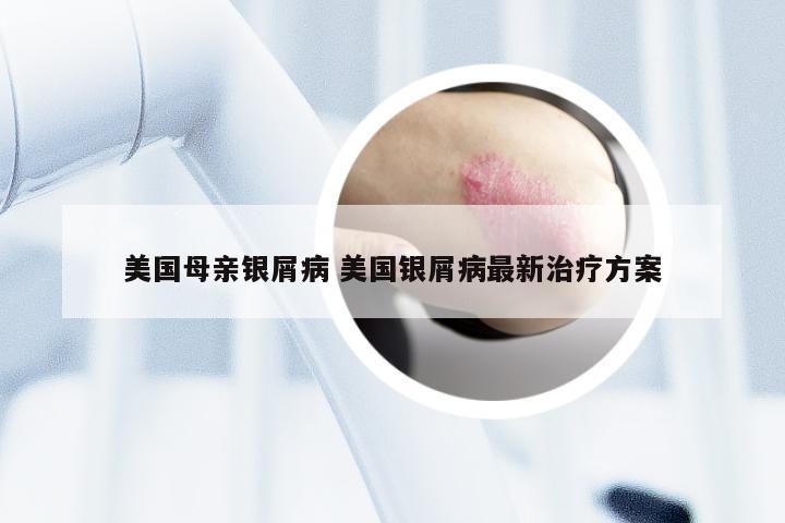 美国母亲银屑病 美国银屑病最新治疗方案