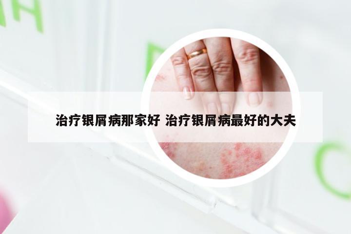 治疗银屑病那家好 治疗银屑病最好的大夫