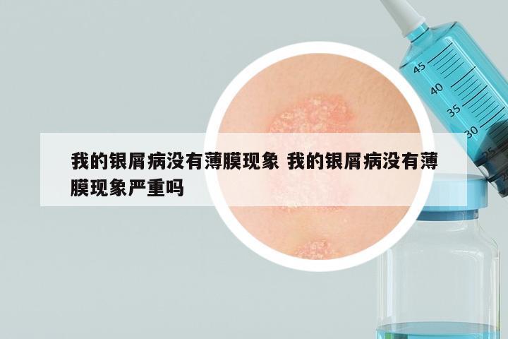 我的银屑病没有薄膜现象 我的银屑病没有薄膜现象严重吗