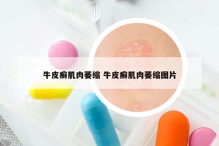 牛皮癣肌肉萎缩 牛皮癣肌肉萎缩图片
