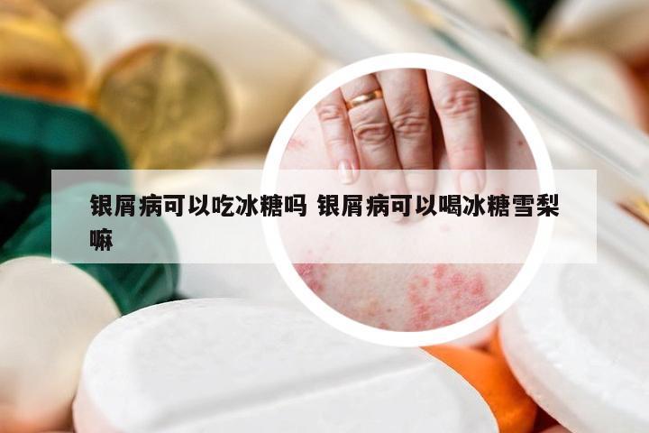 银屑病可以吃冰糖吗 银屑病可以喝冰糖雪梨嘛