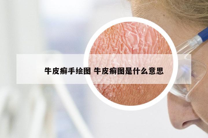 牛皮癣手绘图 牛皮癣图是什么意思