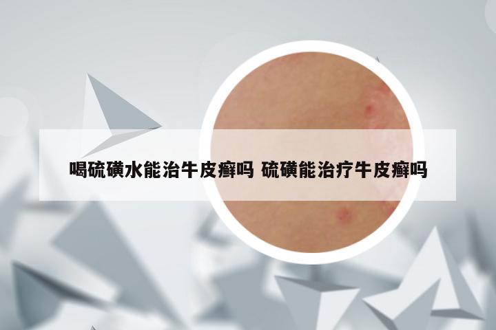 喝硫磺水能治牛皮癣吗 硫磺能治疗牛皮癣吗