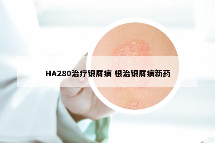 HA280治疗银屑病 根治银屑病新药