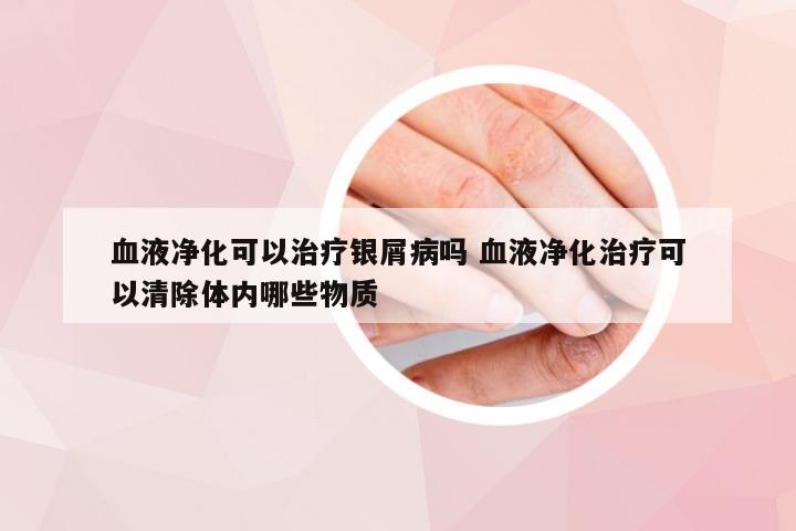 血液净化可以治疗银屑病吗 血液净化治疗可以清除体内哪些物质