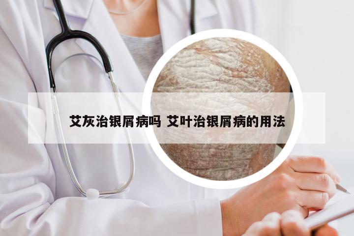 艾灰治银屑病吗 艾叶治银屑病的用法