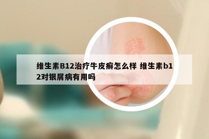维生素B12治疗牛皮癣怎么样 维生素b12对银屑病有用吗