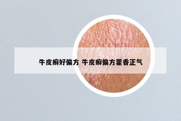 牛皮癣好偏方 牛皮癣偏方藿香正气
