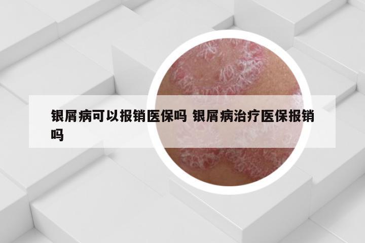 银屑病可以报销医保吗 银屑病治疗医保报销吗