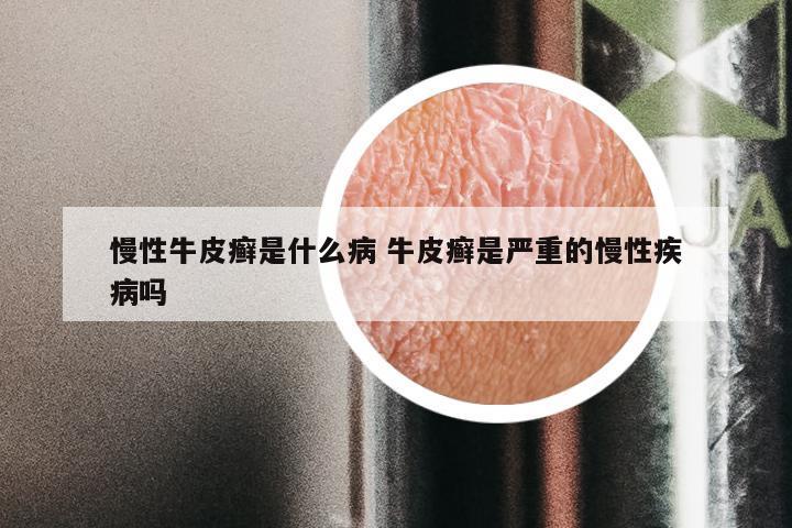 慢性牛皮癣是什么病 牛皮癣是严重的慢性疾病吗
